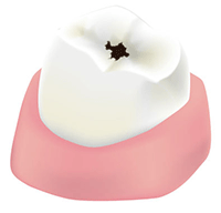 C1…エナメル質のむし歯（歯の表面）